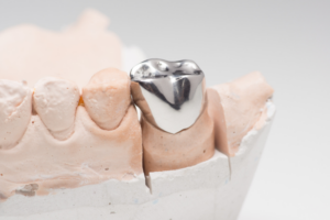 Detailed view of a palladium alloy dental crown mounted on a plaster dental mold
